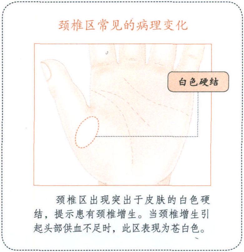 手掌上的頸椎區(qū)